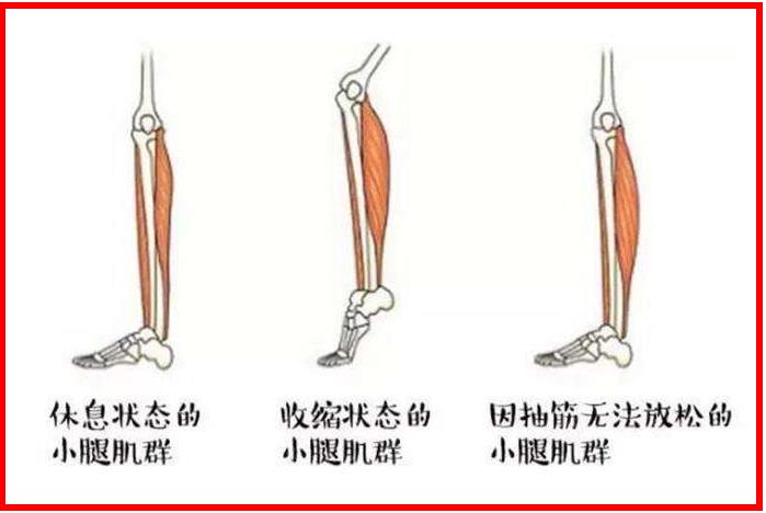 腿部抽筋的三种状态